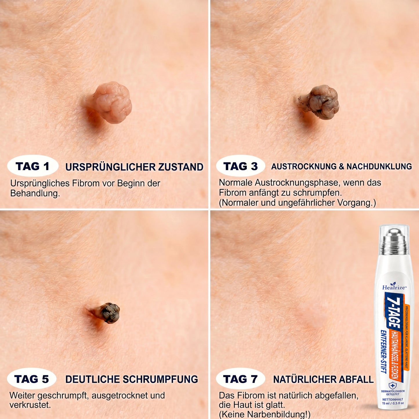 𝐕𝐨𝐧 𝐀𝐩𝐨𝐭𝐡𝐞𝐤𝐞𝐫𝐧 𝐞𝐦𝐩𝐟𝐨𝐡𝐥𝐞𝐧 🥑🥑 𝑯𝗲𝙖𝐥𝒓𝗶𝙯𝗲® 7-Tage Tag & Spot Eraser 🪄 (Rollerball ohne Schmerzen, ohne Narben) 👩‍⚕️