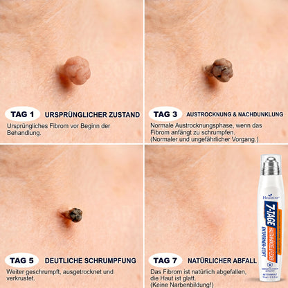 𝐕𝐨𝐧 𝐀𝐩𝐨𝐭𝐡𝐞𝐤𝐞𝐫𝐧 𝐞𝐦𝐩𝐟𝐨𝐡𝐥𝐞𝐧 🥑🥑 𝑯𝗲𝙖𝐥𝒓𝗶𝙯𝗲® 7-Tage Tag & Spot Eraser 🪄 (Rollerball ohne Schmerzen, ohne Narben) 👩‍⚕️